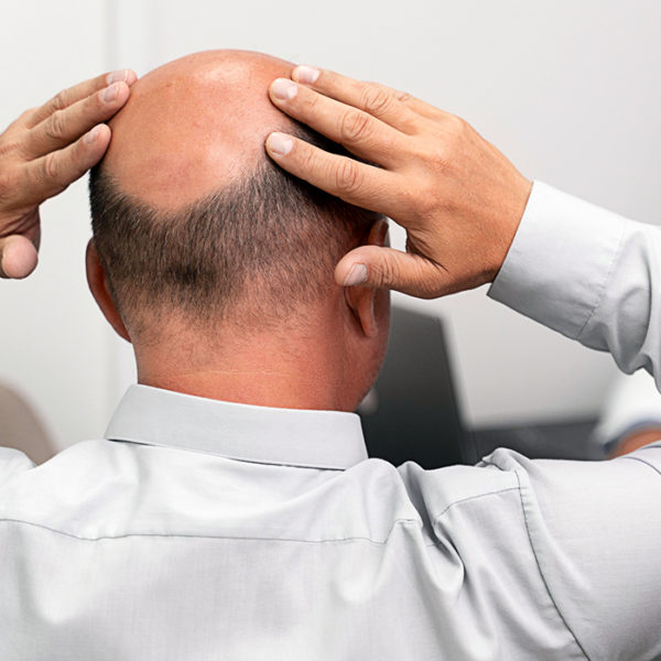 Why Men Go Bald And The Perfect Hairstyle For Your Age